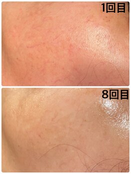 キュアフロウ 橿原店/〈赤ら顔緩和〉気になる悩み◎