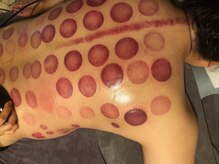 中国整体 らくらく堂/温熱療法吸い玉デトックス