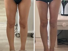 ナースのロミリンパ/リンパマッサージでスッキリ