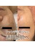【人気No,1★ノーファンデ艶肌へ】ハーブピーリング+高濃度美容液導入