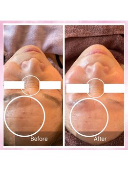 リュミエール デスポワール(Lumiere d'espoir)/ハーブピーリング