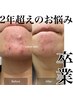 【繰り返す肌荒れに】幹細胞ハーブピーリング　21450円→14300円