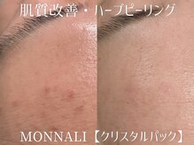 シュアショット(SURE SHOT)/ハーブピーリング