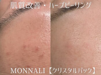 シュアショット(SURE SHOT)/ハーブピーリング