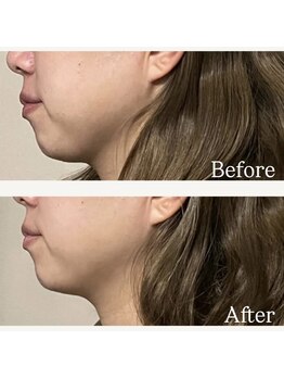 リタ(Rita.)/顎下スッキリ!