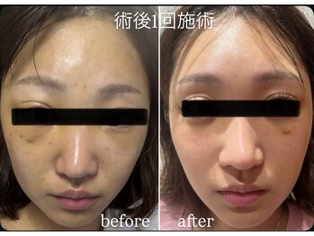 ミカド 銀座(mikado)/クマ取り/ビフォーアフター