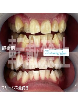 ホワイトニングサロン 福岡天神店/ホワイトニング
