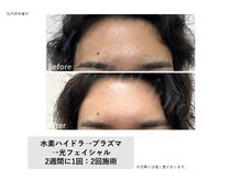 トータルクリア(TOTAL CLEAR)/水素ハイドラ×プラズマ×光