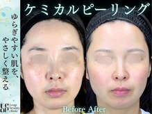 くすみや色ムラを改善し透明感のある均一な肌トーンへ導く施術です