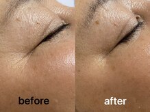 ユイット ルッカ(Huit Lucca)/アクアダーマ×高濃度幹細胞導入