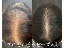 大人気のプロセルセラピーズ育毛促進／メンズも歓迎