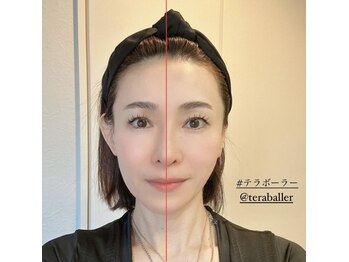 ラキネイ 目黒(Lakinei)/テラボーラー、美顔筋SOSEI効果