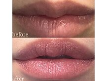 ワイズ 沖縄うるま院(Medical Y's)/ローマピンク症例唇