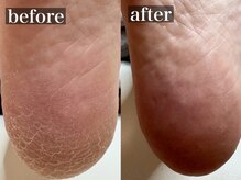 しあん 京都/踵のガサガサ