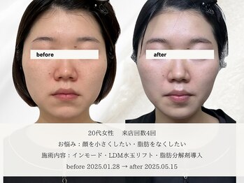 エメ 名古屋栄店(aimer)/LiftCare <小顔・リフトアップ>