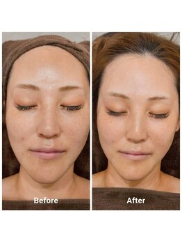 ミル(milu)/美肌へ☆ヒト幹細胞フェイシャル