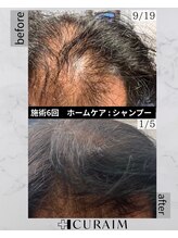 キュライム 熊本(CURAIM)/育毛促進【60代男性】