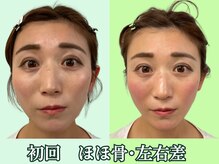 ナチュラルパーフェクトフェイス 新宿/３２才頬骨・左右差/新宿小顔