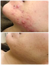 アンジェロ/【ニキビケア】肌育プログラム