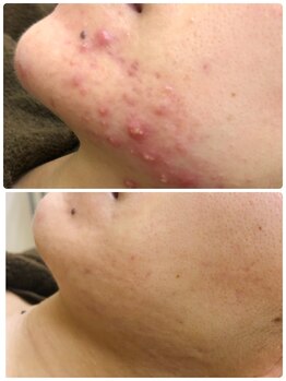 アンジェロ/【ニキビケア】肌育プログラム