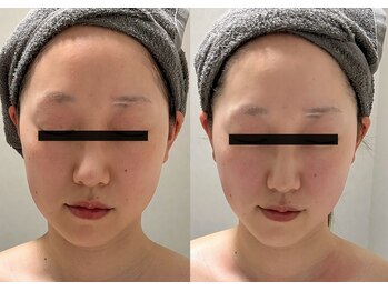 エレーナ(ELENA)/小顔コルギ30分