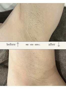 モアトゥインクル 福山神辺店(MORE twinkle)/初めての方に人気の「脇」脱毛 