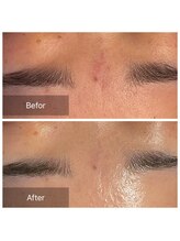 ブランスパ(Bulan Spa)/眉間の肌バリア低下による赤み