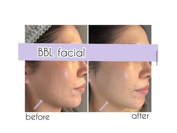 グラント(grant)/【BBL】ビフォーアフター