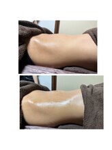 アール(R)/テスラセラピー1回の効果！