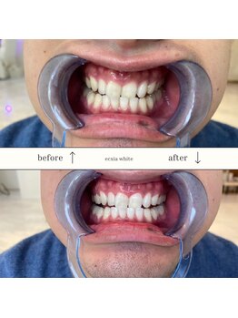 エクシアホワイトニング 沖縄宮里店/お客様ビフォア