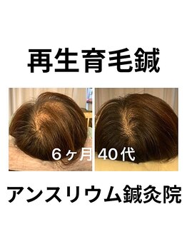 アンスリウム美容整体院 鍼灸院 接骨院/育毛を促す鍼