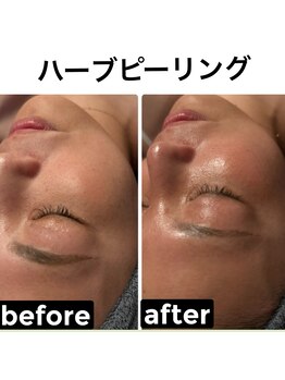 アンベリール(embellir)/肌トラブル解消ハーブ！