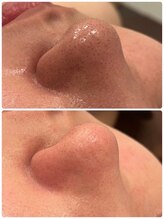 ファーストクラス(First Class)/ハイドラフェイシャル