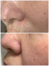 エムドット(M.)/毛穴洗浄