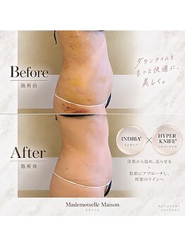 マドモアゼルメゾン 恵比寿(マドモアゼルMaison)の写真/【術前・術後ケア専門】最新インディバ時間内かけ放題◎複数部位もまとめて徹底ケア♪