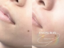 ワクシングトウキョウアイス 北千住西口店(waxing tokyo ice)/口周り