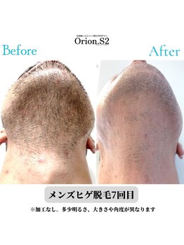 オリオンドットエスツー(Orion.S2)/【Before→After】