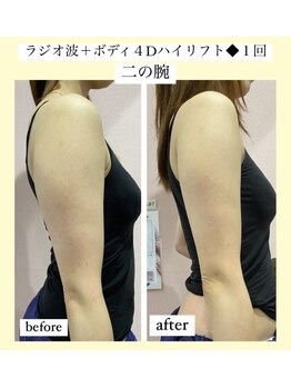 ルピナス ヒサヤ(LUPINUS hisaya)/4Dスーパーリフトはボディにも☆