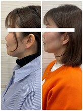 長寿鍼灸院 長寿整骨院/ハリネズミ女優美容鍼効果★