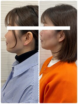 長寿鍼灸院 長寿整骨院/ハリネズミ女優美容鍼効果★