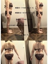 エステサロンルシア (LUCIA)/ラジオ波セル吸引撃退90分コース