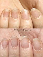 マリーロール 梅田店(Marie Laure)/自爪育成/深爪矯正/ネイルケア