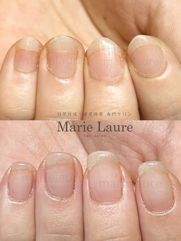 マリーロール 梅田店(Marie Laure)/自爪育成/深爪矯正/ネイルケア
