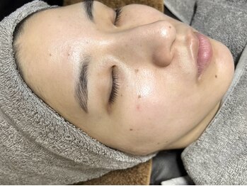 アネラ(ANELA)の写真/【話題の美容液も導入！】毛穴の開き、黒ずみ、皮脂詰まり、肌荒れ、ニキビ、産毛などにお悩みの方に◎