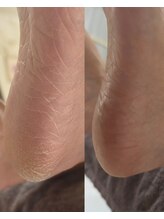 ネイルズ ビー 南昭和町本店(Nail's be)/角質ケア