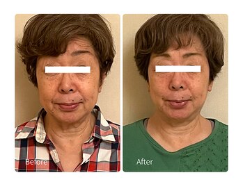 ベルソー(Berceau)/