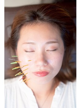 海真堂鍼灸整骨院/01)美容鍼