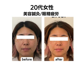 シン(SHINE)/美容鍼灸