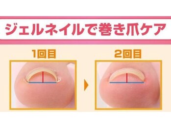 フットケアリストシュウ(footcarelist shu)/施術【巻き爪】最新巻き爪ケア