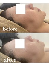 ザモア 福岡天神(THE MORE)/ララピートでうるツヤ水光肌